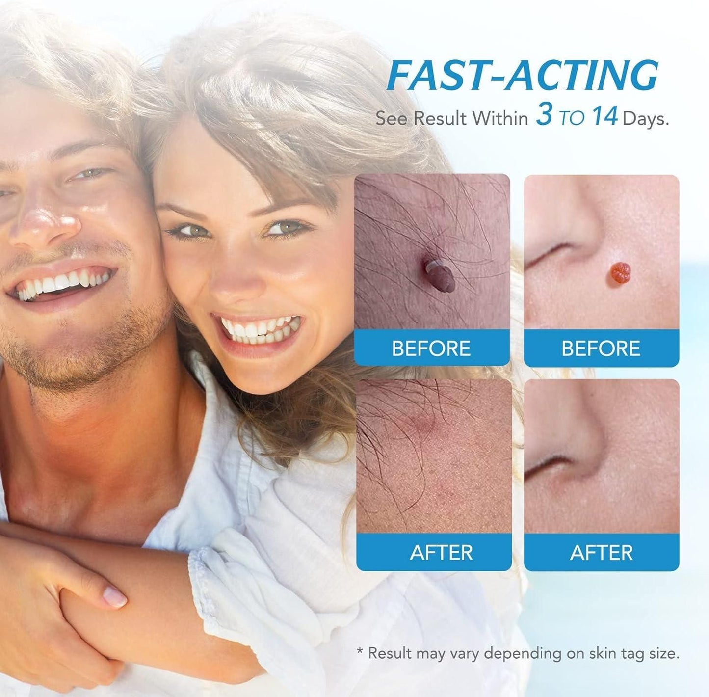 Skin Tag Remover Kit - Painless