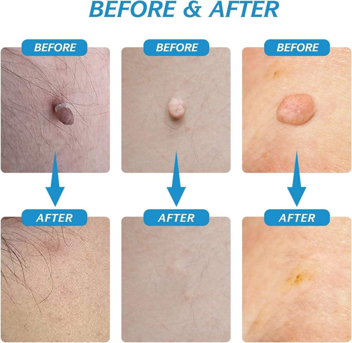 Skin Tag Remover Kit - Painless